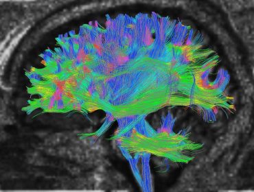 Advanced MRI - DTI Advanced Brain MRI - DTI